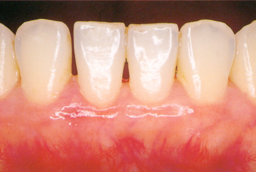 改善した歯肉